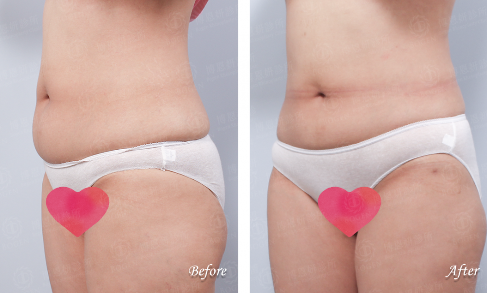 腹部抽脂,瘦小腹,博恩妍